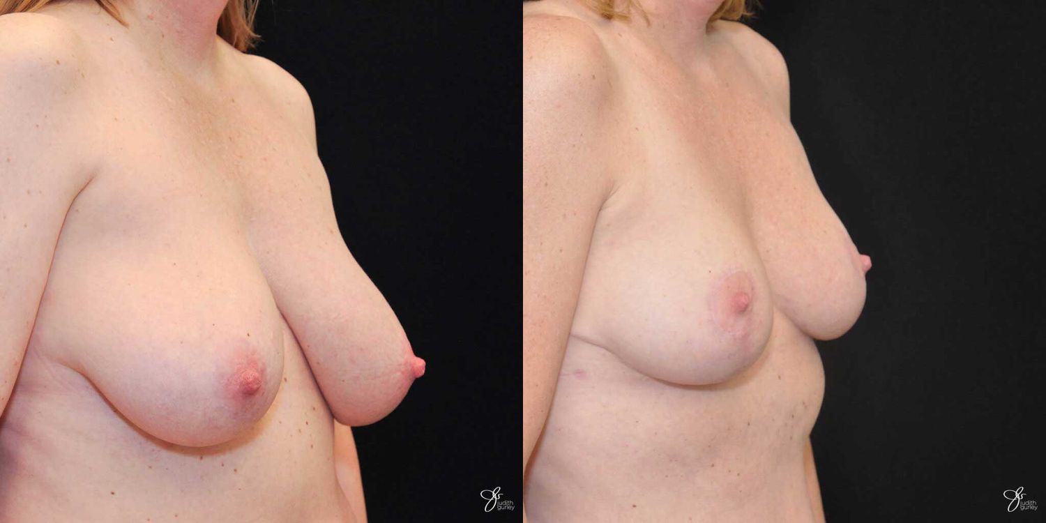 Asymmetry Correction Before & After