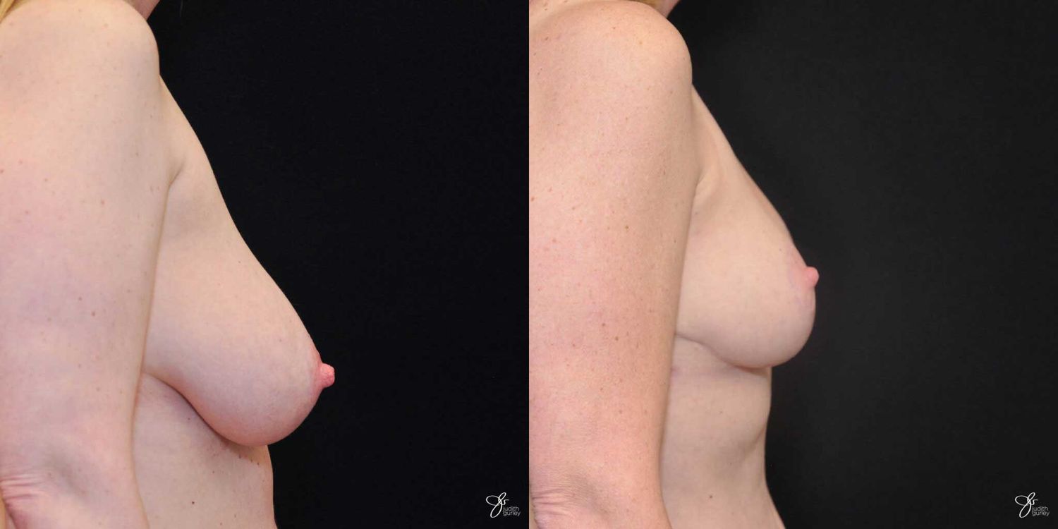 Asymmetry Correction Before & After