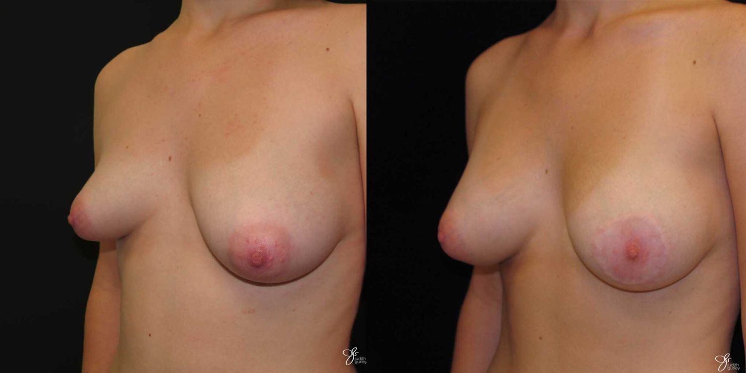 Asymmetry Correction Before & After