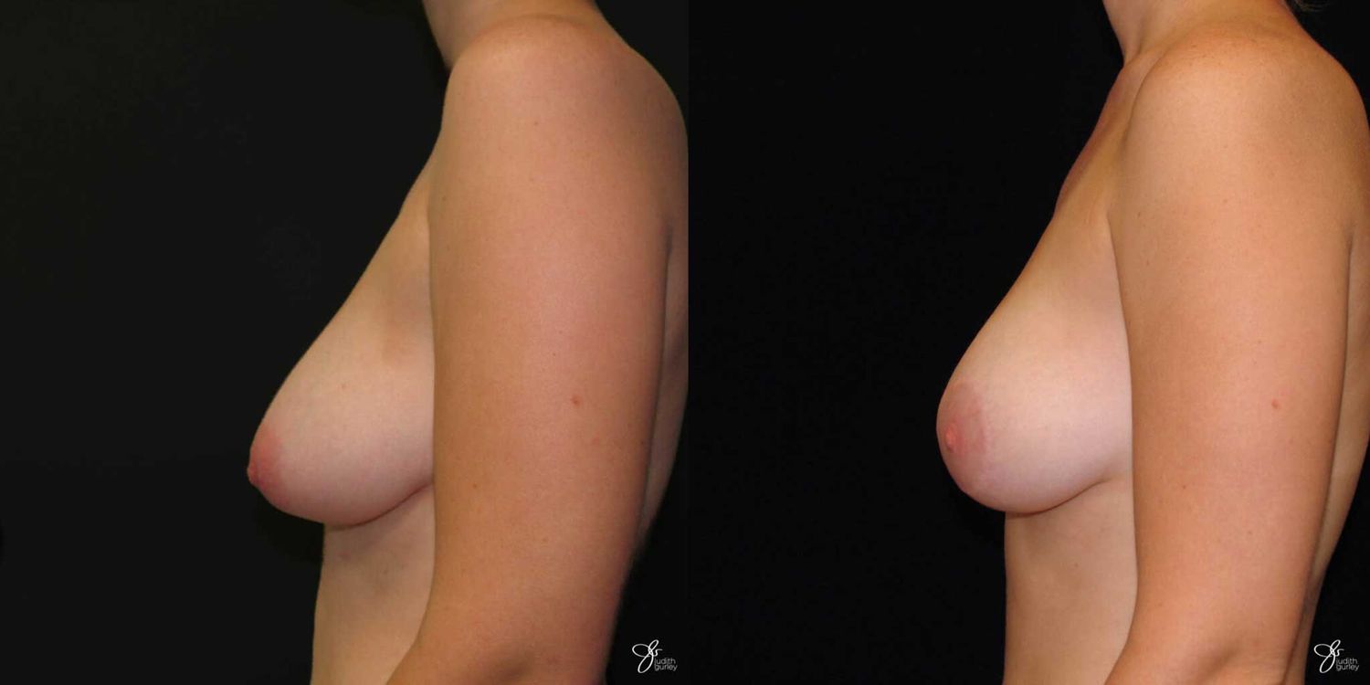 Asymmetry Correction Before & After