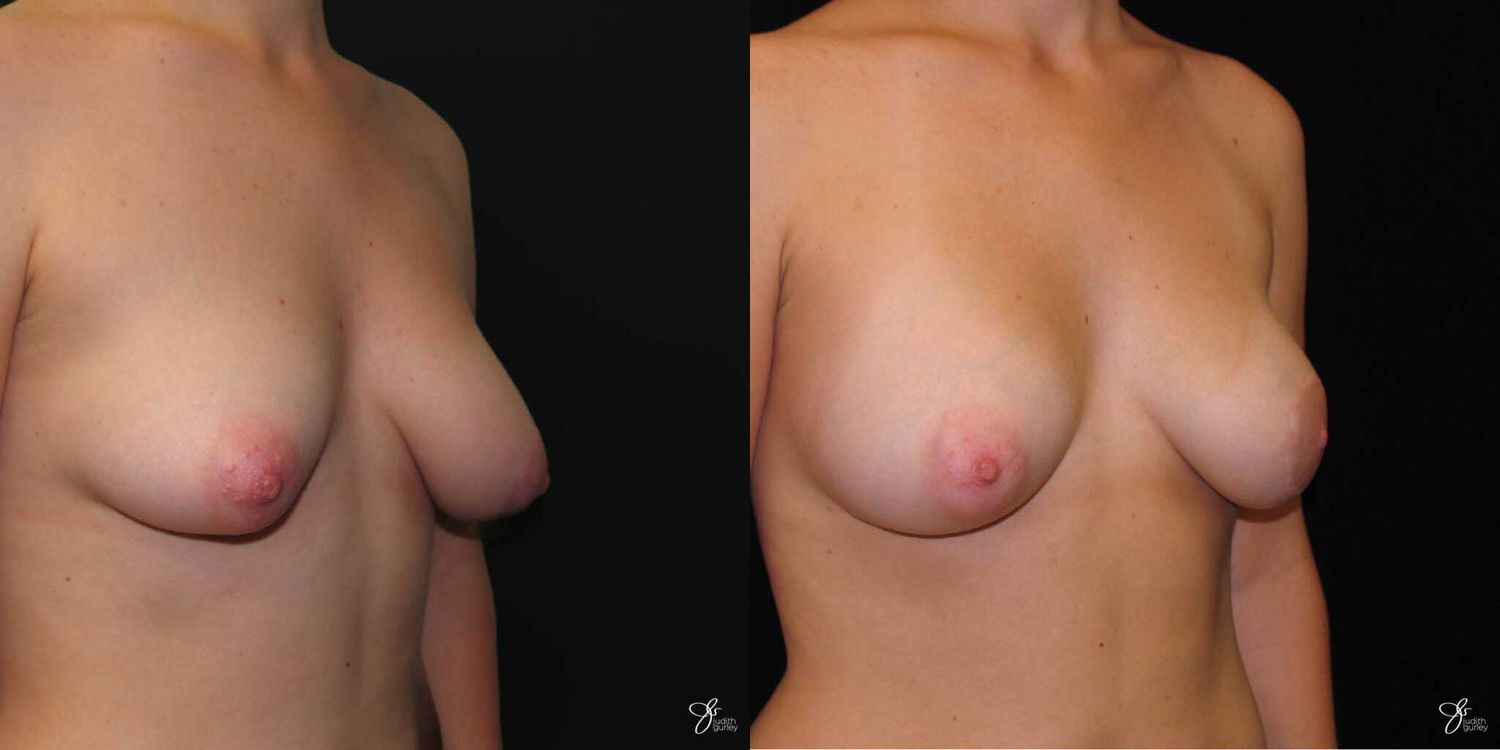 Asymmetry Correction Before & After