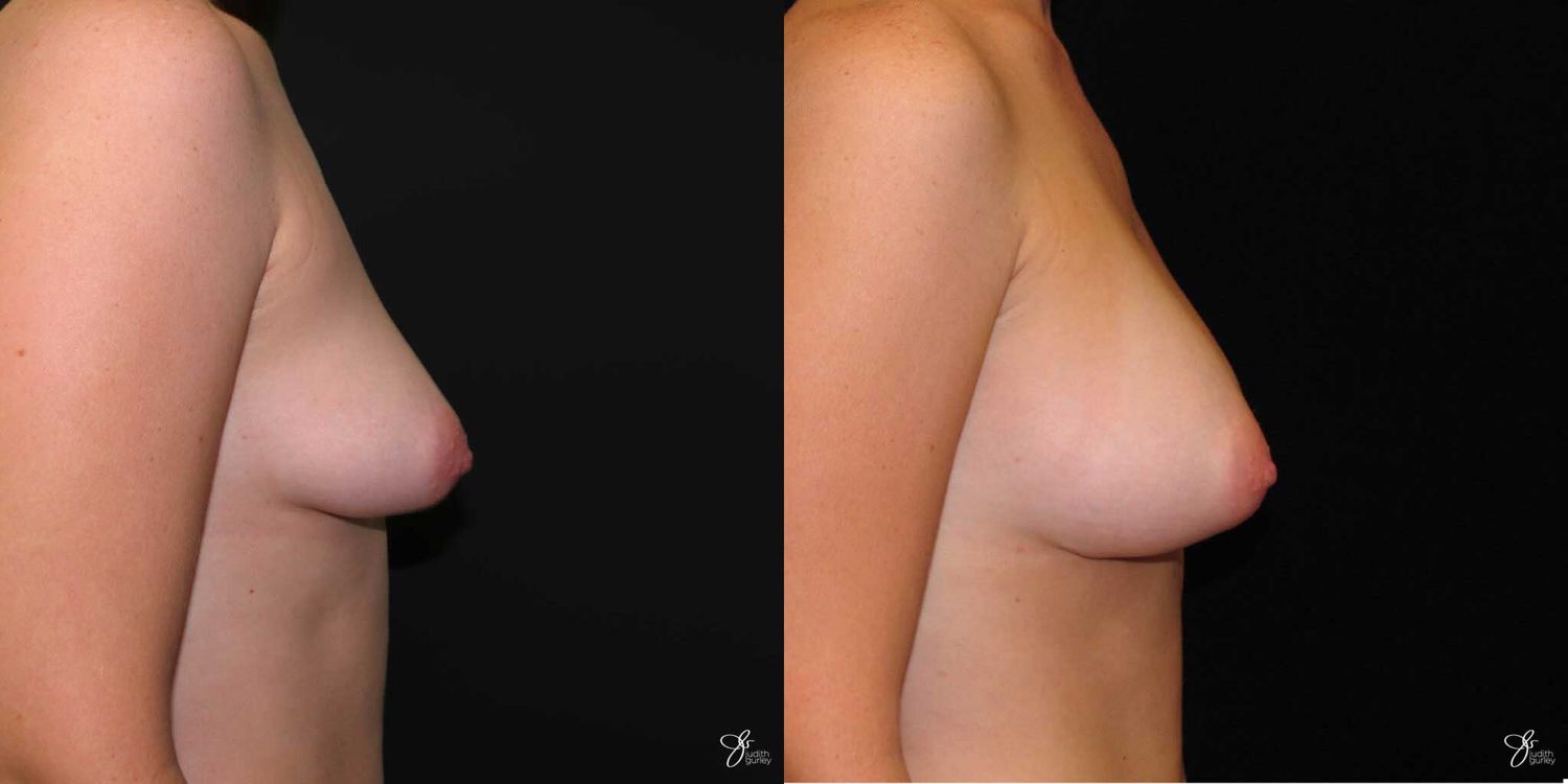 Asymmetry Correction Before & After