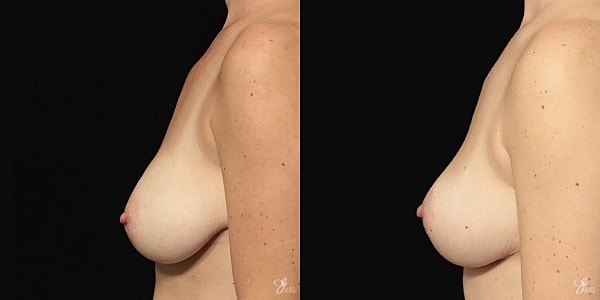 Breast Lift Before & After