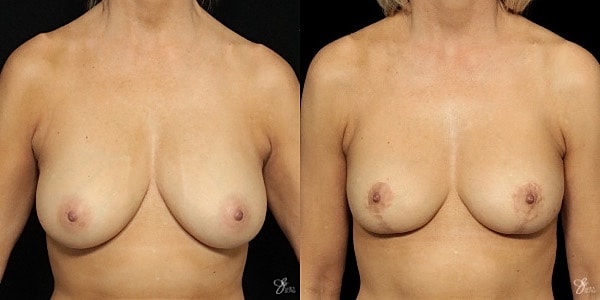 Breast Lift Before & After