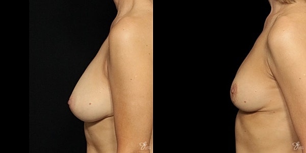 Breast Lift Before & After