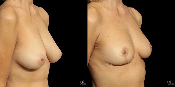 Breast Lift Before & After