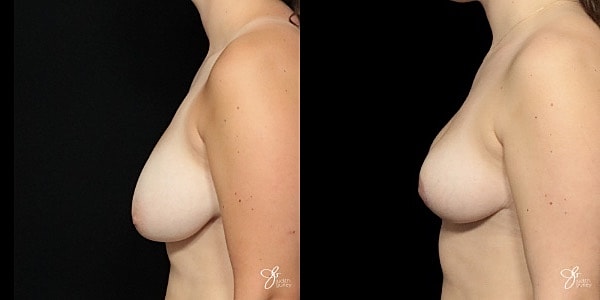 Breast Lift Before & After