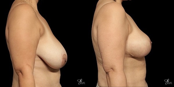 Breast Lift Before & After