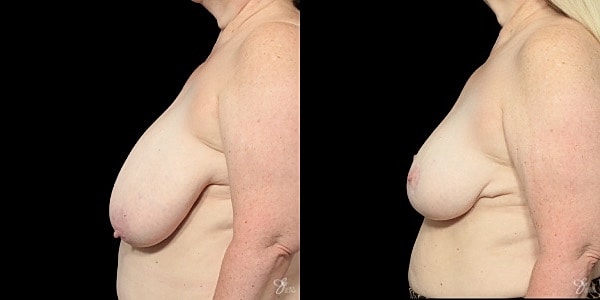 Breast Lift Before & After