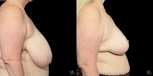 Breast Lift Before & After