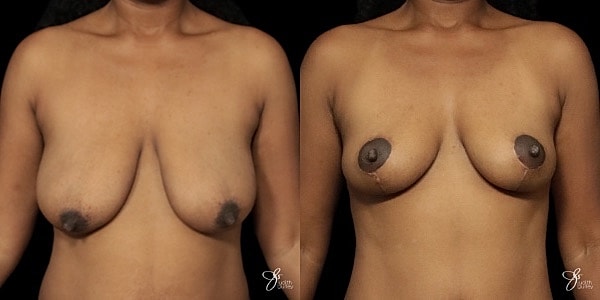 Breast Lift Before & After