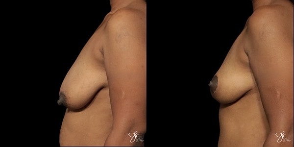 Breast Lift Before & After