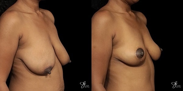 Breast Lift Before & After