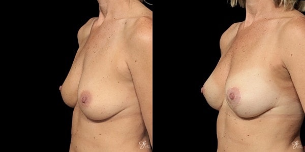 Breast Lift Before & After