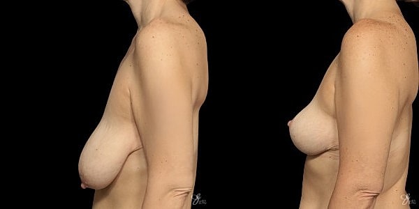 Breast Lift Before & After