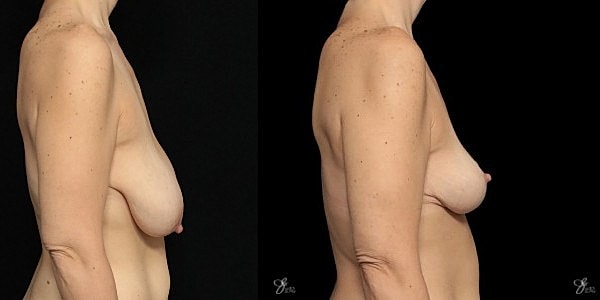 Breast Lift Before & After