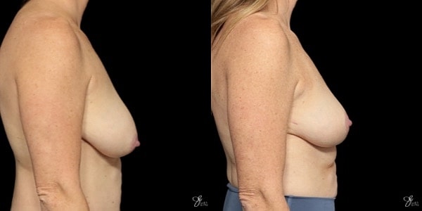 Breast Lift Before & After