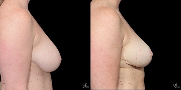 Breast Lift Before & After