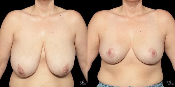 Breast Lift Before & After