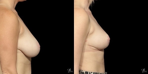 Breast Lift Before & After