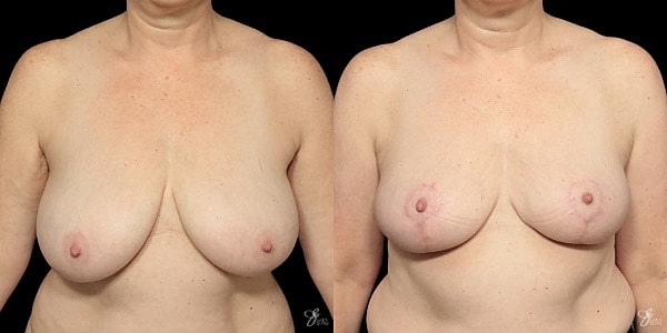 Breast Lift Before & After