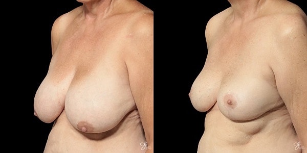 Breast Lift Before & After