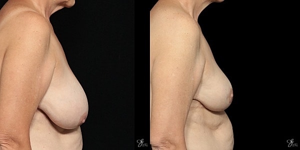 Breast Lift Before & After
