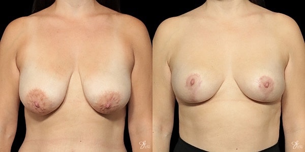 Breast Lift Before & After