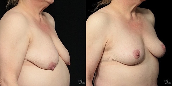 Breast Lift Before & After