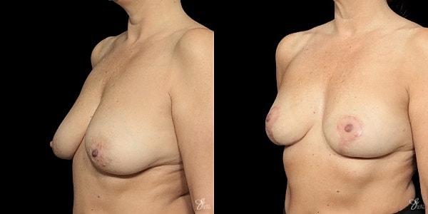 Breast Lift Before & After