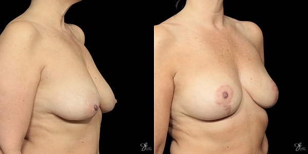 Breast Lift Before & After