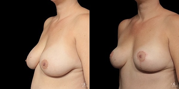 Breast Lift Before & After