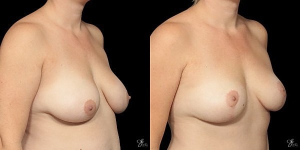 Breast Lift Before & After