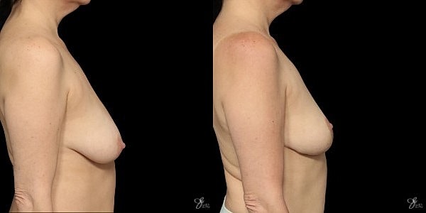 Breast Lift Before & After