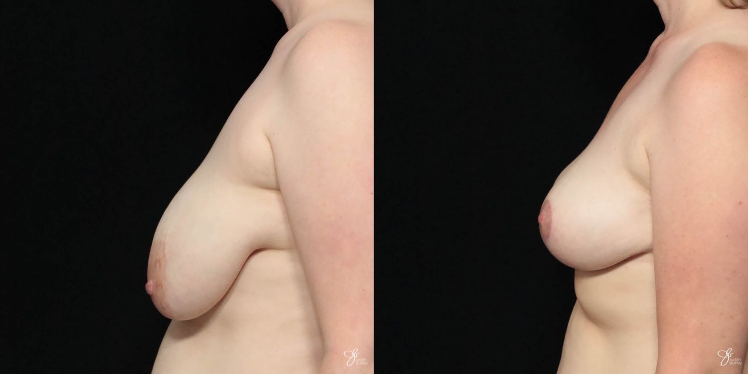 Breast Lift Before & After