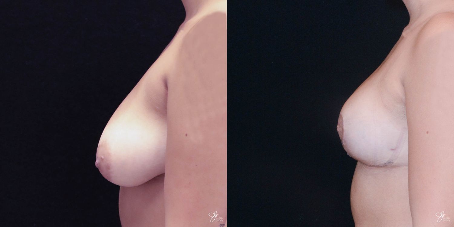 Breast Lift Before & After
