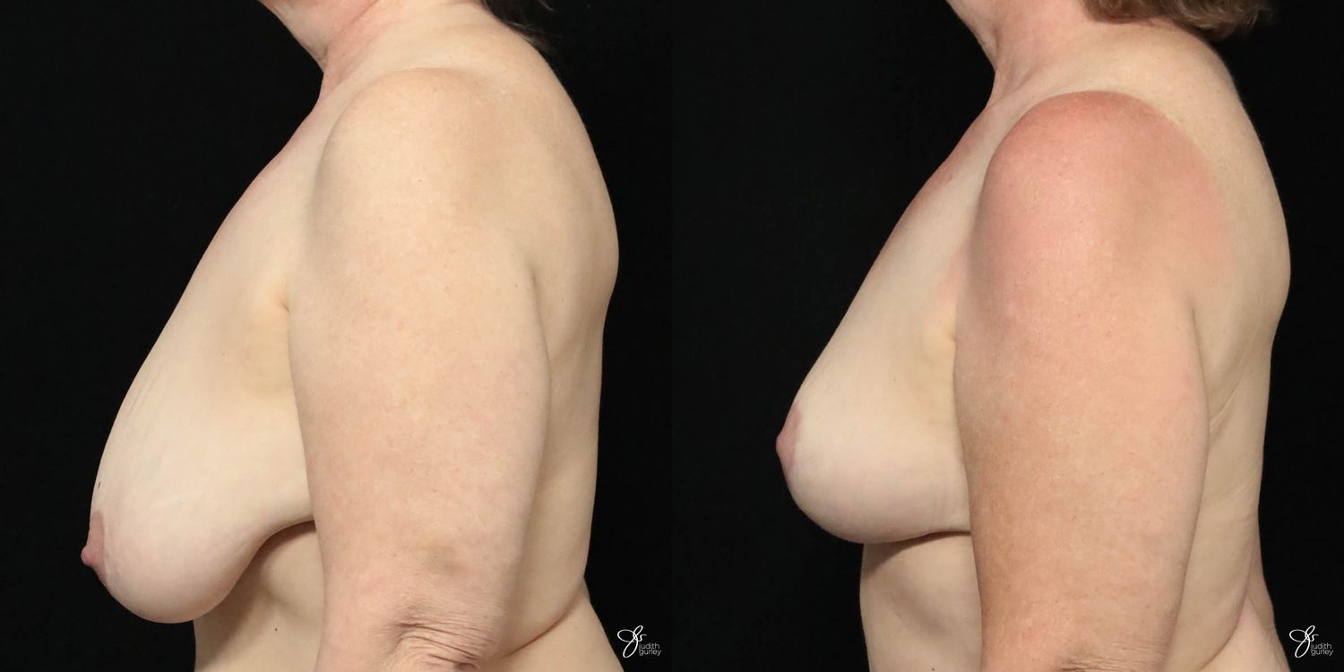 Breast Lift Before & After