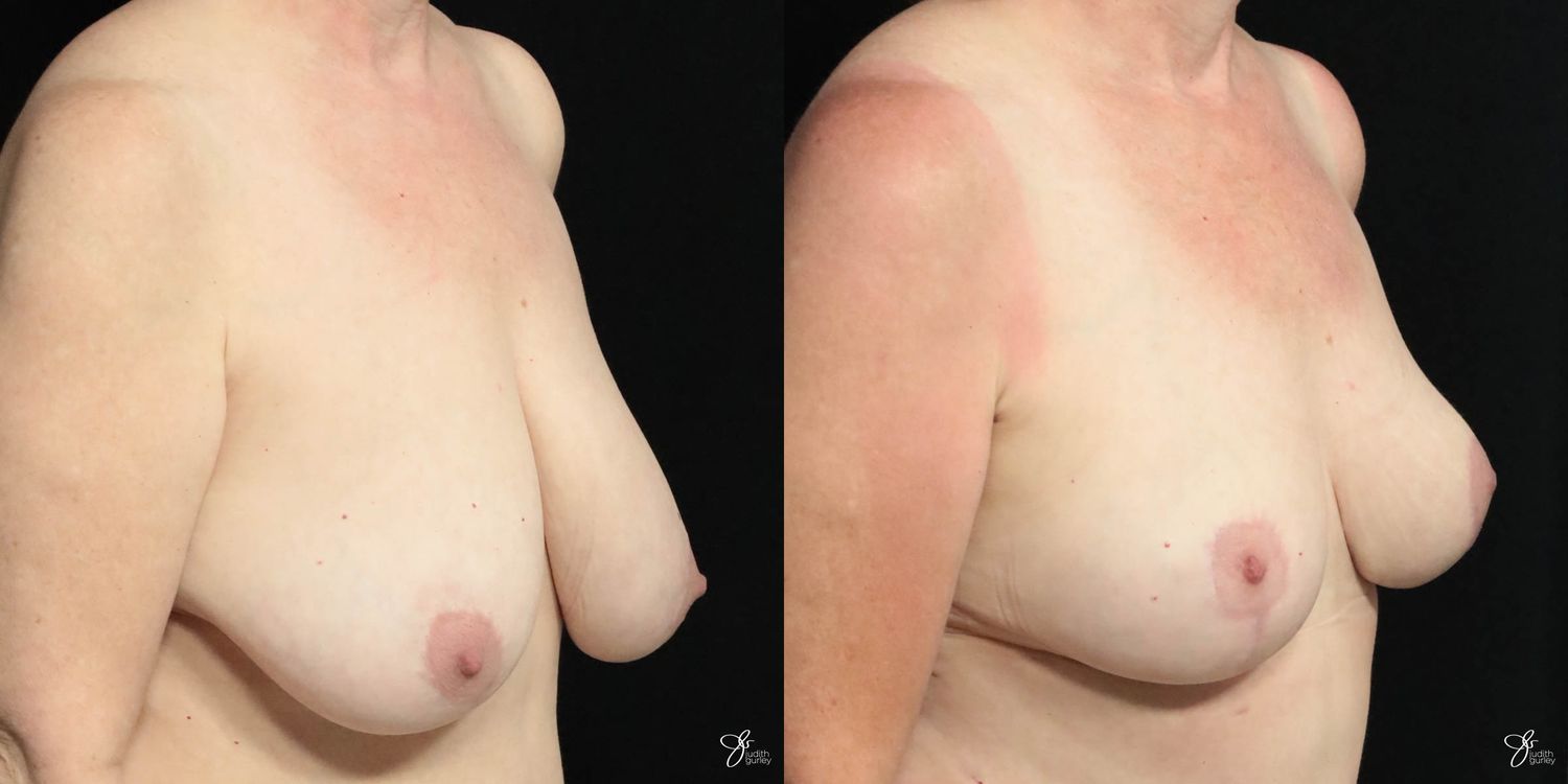 Breast Lift Before & After