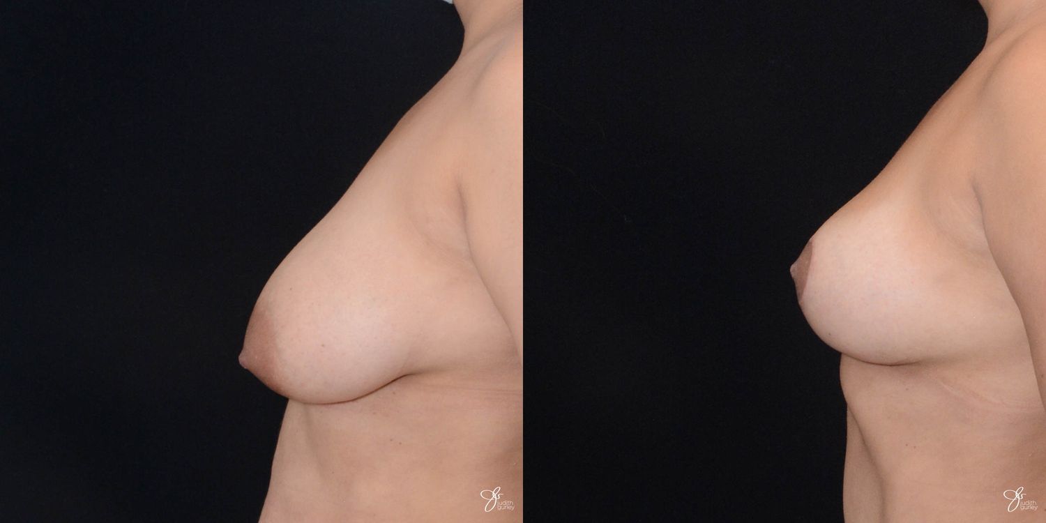 Breast Lift Before & After
