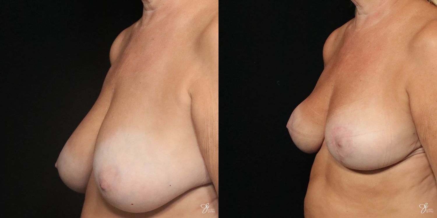Breast Lift Before & After