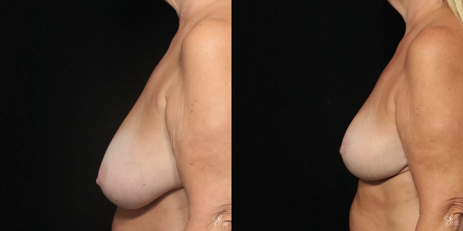 Breast Lift Before & After