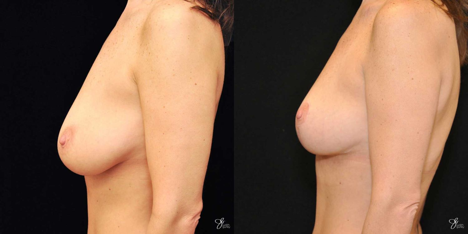 Breast Lift Before & After