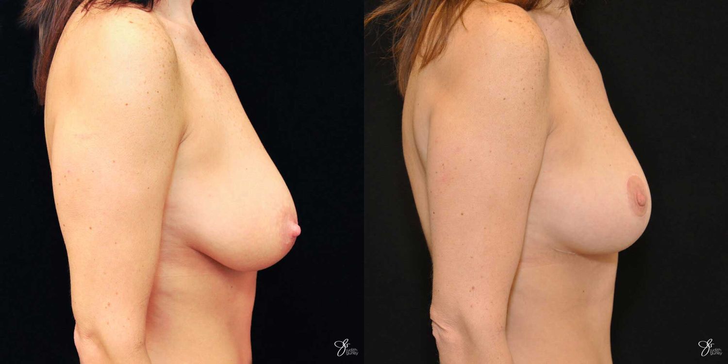 Breast Lift Before & After