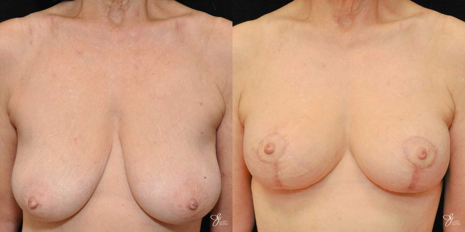 Breast Lift Before & After