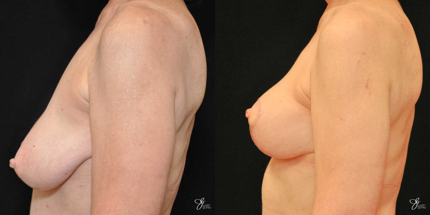 Breast Lift Before & After