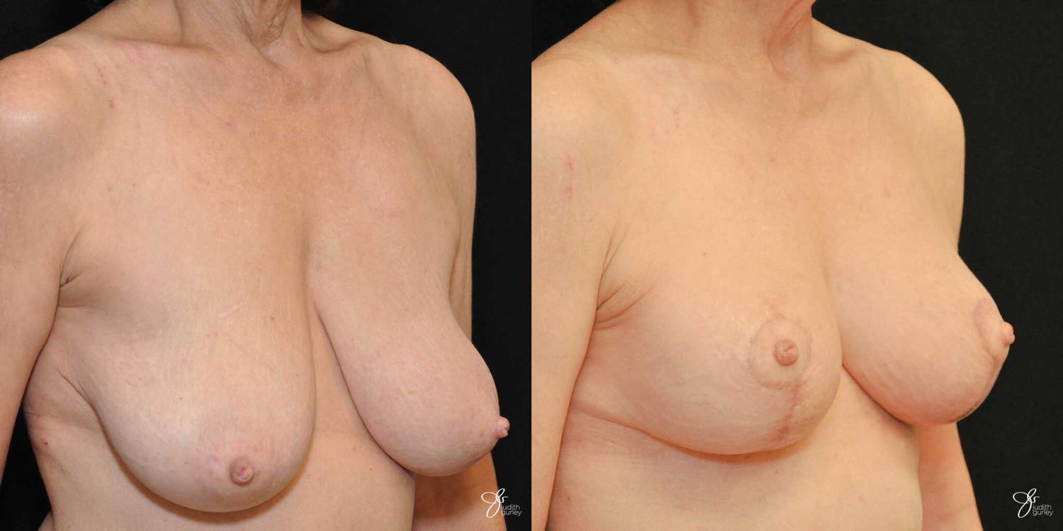 Breast Lift Before & After