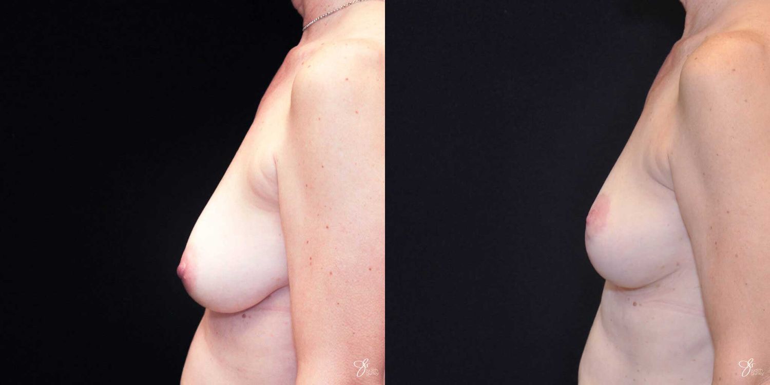 Breast Lift Before & After