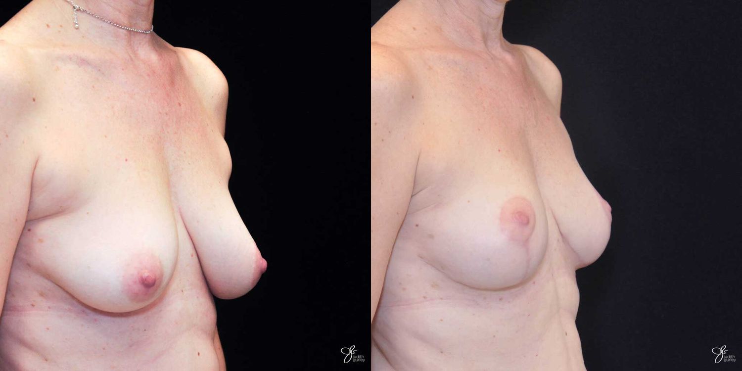 Breast Lift Before & After