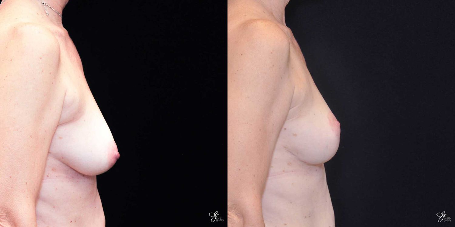 Breast Lift Before & After