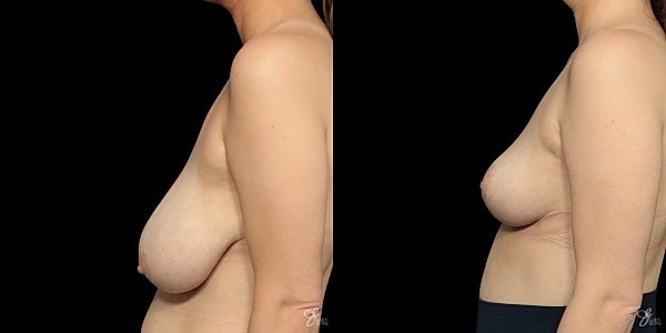 Breast Lift Before & After